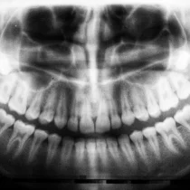 Utilización del protector tiroidal en la radiología dental en Sevilla
