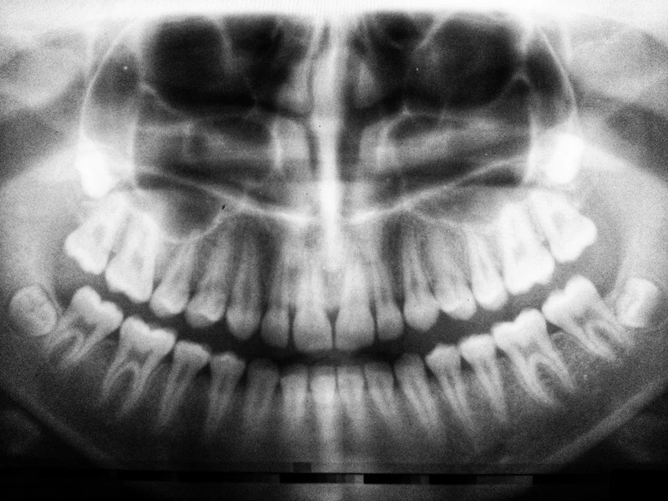 Utilización del protector tiroidal en la radiología dental en Sevilla