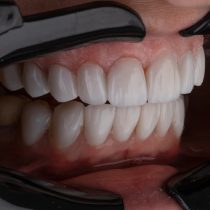 Implantes Dentales en Sevilla con Antonio Losada Clínica Dental: Recupera tu Sonrisa con Confianza