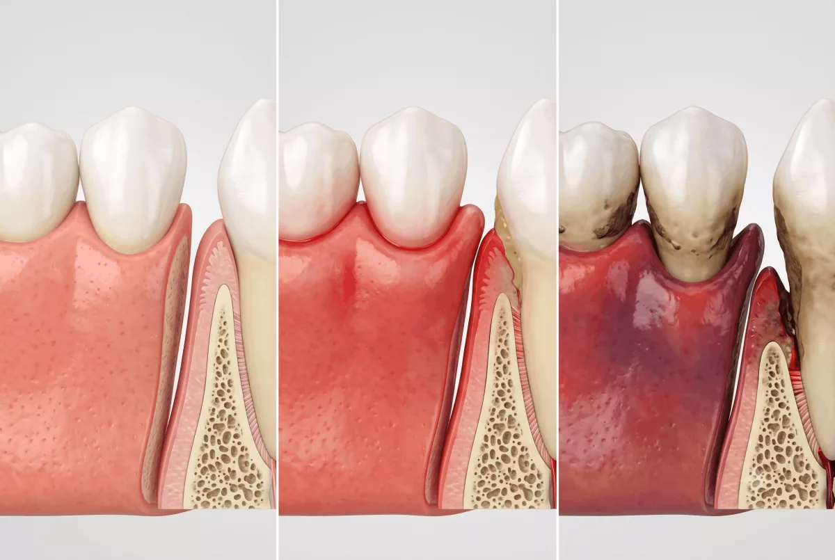 Periodoncia en Sevilla: cuándo revisar la salud de las encías